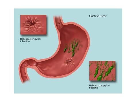 Gastritis después de erradicar helicobacter