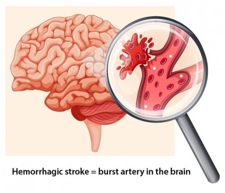 Stroke, its types and symptoms - Online Science Notes